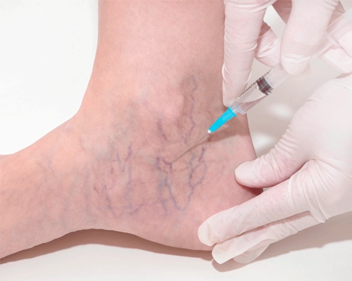 Escleroterapia tradicional - Tratamento de Varizes