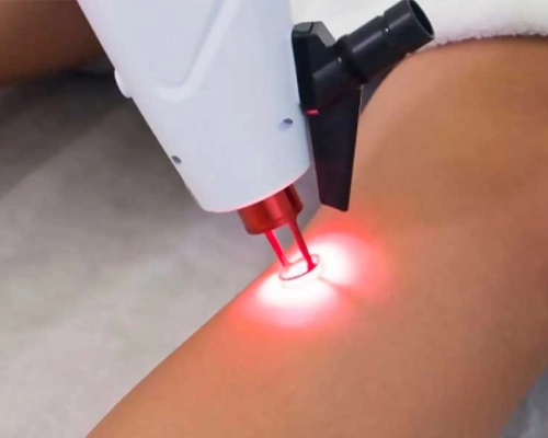 Equipamento de Laser Transdérmico para tratamento de varizes