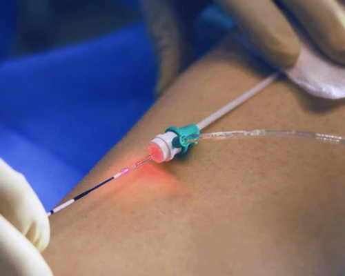 Endolaser - Laser Endovenoso