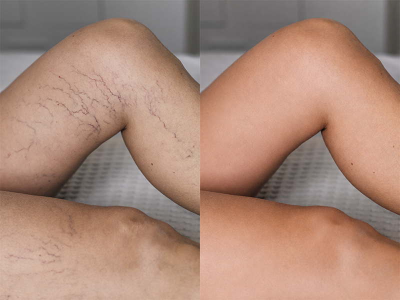 Resultado de Tratamento Vascular 3
