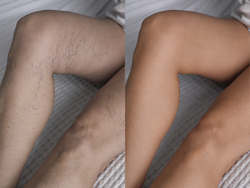 Resultado de Tratamento Vascular 2